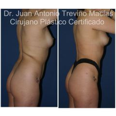 Lipoescultura - Centro de Cirugía Plástica. Dr. Juan Antonio Treviño Macías