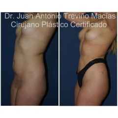Lipoescultura - Centro de Cirugía Plástica. Dr. Juan Antonio Treviño Macías