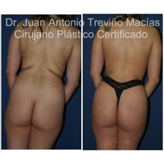Lipoescultura - Centro de Cirugía Plástica. Dr. Juan Antonio Treviño Macías