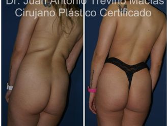 Lipoescultura antes y después - 875623