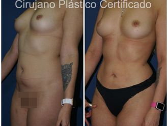 Lipoescultura antes y después - 875624