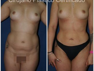 Lipoescultura antes y después - 875625