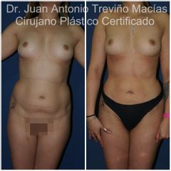 Lipoescultura - Centro de Cirugía Plástica. Dr. Juan Antonio Treviño Macías