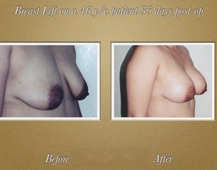 Antes y después Mastopexia