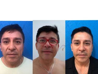 Antes y después de Lipoinyección facial