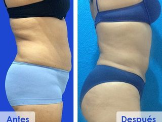 Antes y después de abdominoplastia