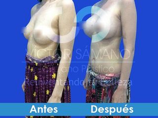 Antes y después de aumento de senos