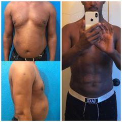 Antes y después de Liposucción HD