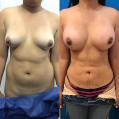 Antes y después de Liposucción & Aumento de Busto