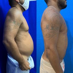 Antes y después de Liposucción