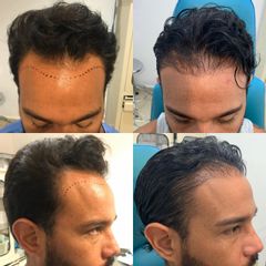 Antes y después de Trasplante de cabello 