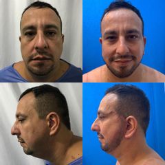 Face lift - Dr. Víctor Genaro Sámano Guzmán