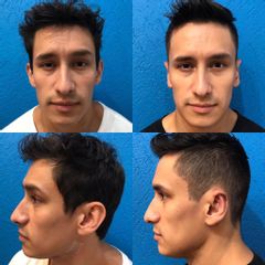 Antes y después de Otoplastia