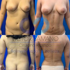 Antes y después Dr. Víctor Genaro Sámano Guzmán