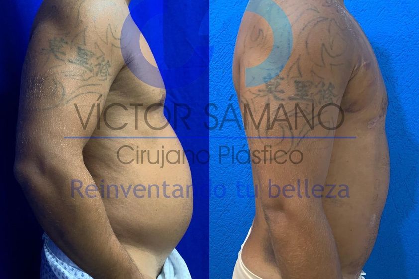 Liposucción antes y después - 837413