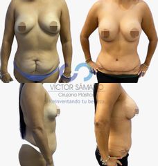 Antes y después