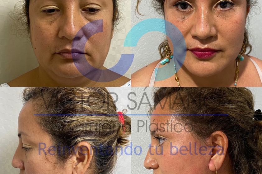 Lifting antes y después - 855644