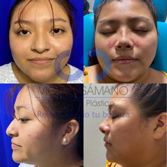 Rinoplastia - Dr. Víctor Genaro Sámano Guzmán