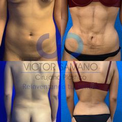 Liposucción - Dr. Víctor Genaro Sámano Guzmán
