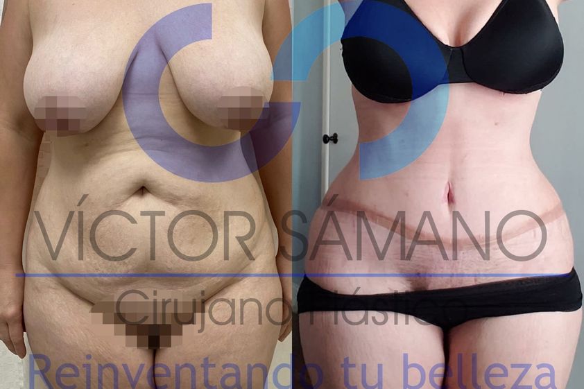 Abdominoplastia antes y después - 855651