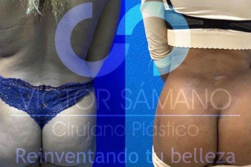 Gluteoplastia antes y después - 867175