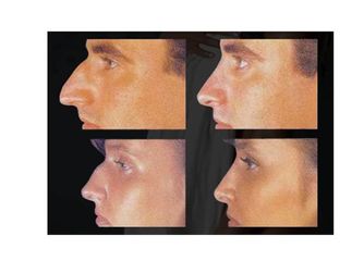 Antes y después de Rinoplastia