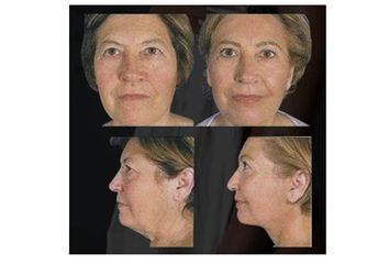 Antres y después de rejuvenecimiento facial 