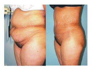 Antes y después de Abdominoplastia