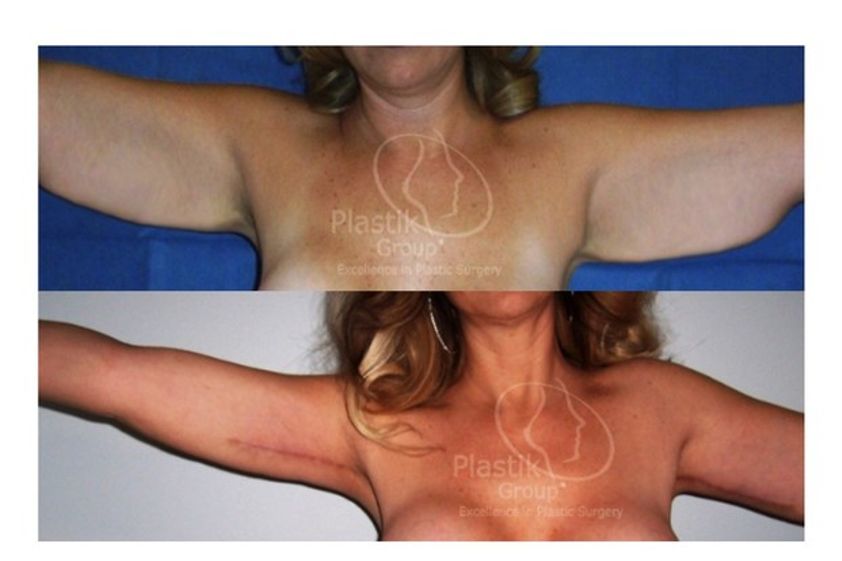 Braquioplastia antes y después - 623945