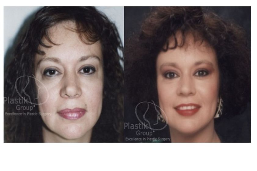 Lifting antes y después - 623947