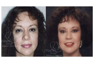 Antes y después de Facelift y eliminar cicatriz de la mandíbula
