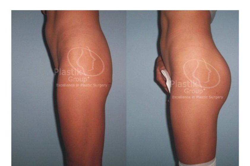 Gluteoplastia antes y después - 623949