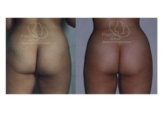 Antes y después de Lipoinyección de glúteos