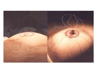 Antes y después de Rec-AREOLAR
