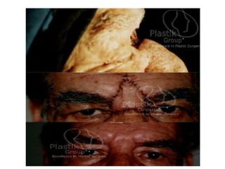 Antes y después de Rec-Ca espinosel