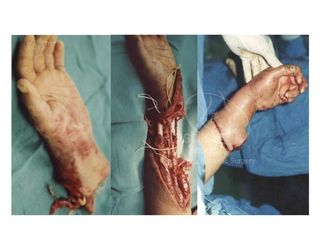 Antes y después de Reimplante de mano