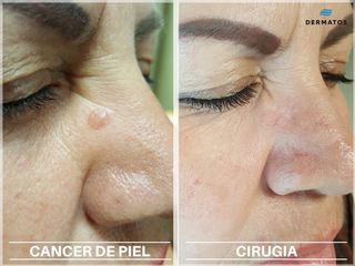 Cáncer de piel: Antes y después de tratamiento 