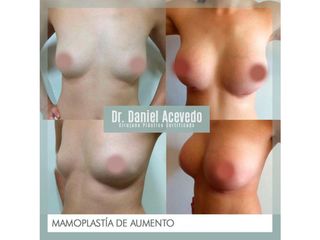 Antes y después de Aumento de busto