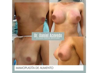 Antes y después de Aumento de busto