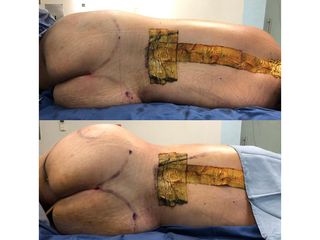 Antes y después de Liposucción