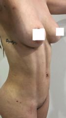 Abdominoplastia