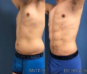 Antes y después de Abdominoplastia