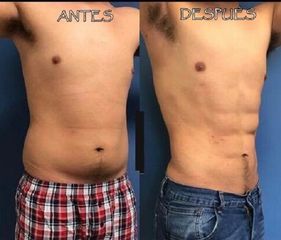 Antes y después de Abdominoplastia