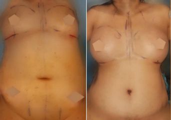 Antes y después de Abdominoplastia