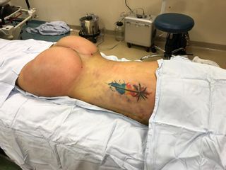 Gluteoplastia