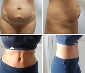 Antes y después de Abdominoplastia