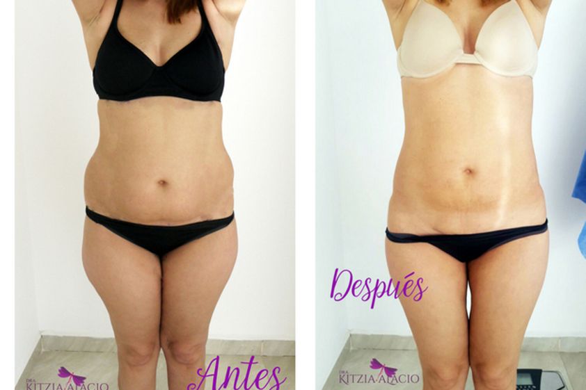 Lipólisis antes y después - 624792