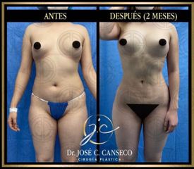 Lipoescultura - Dr. José Carlos Canseco Cavazos