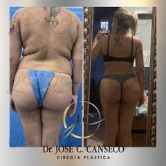 Lipoescultura - Dr. José Carlos Canseco Cavazos
