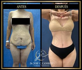 Mommy Makeover - Dr. José Carlos Canseco Cavazos